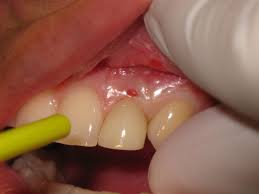 gum disease